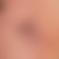 Spider veins. Multiple, radially spread, radiating vascular dilatations of different calibre, par...