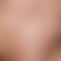 Spider veins. 35-year-old female patient. The linear erythema (compressible by glass spatula pres...