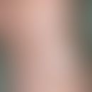 Betknie. Umschriebene Hyperkeratose im Bereich des Knies.