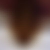 bedbug. bedbug Cimex lectularius: ventral view of the head. from bottom to top: antennae, eyes, i...