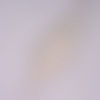 Bilharziose. Ei von Schistosoma intercalatum. Im Vergleich zu Schistosoma haematobium besitzt Sch...
