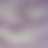 Bilharziose. Appendix-Biopsat mit Schistosoma japonicum. Es beginnt sich ein eosinophiles Granulo...
