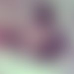 Bilharziose. Eier von Schistosoma japonicum im Appendix-Biopsat.