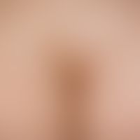 Connective tissue nevus, lumbosacral. 30-year-old woman, in whom these changes had been present s...