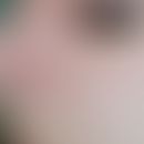 Birt-Hogg-Dubé syndrome: Multiple, skin-coloured, flesh-coloured and whitish, partly waxy, relati...