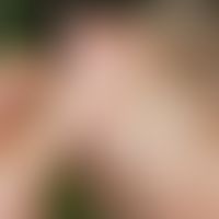 Birt-Hogg-Dubé syndrome: Multiple, skin-coloured, flesh-coloured and whitish, partly waxy, relati...