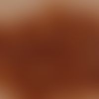 BK-Mole-Syndrom, Auflichtmikroskopie, retikuläres&nbsp;Pigmentmuster noch erhalten.
