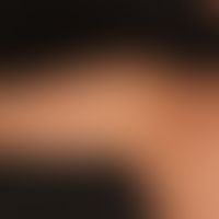 BK-Mole Syndrome
