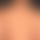 BK-Mole syndrome: multiple irregularly configured and stained melanoytic nevi. condition after su...