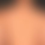 BK-Mole-Syndrom: multiple unregelmäßig konfigurierte und gefärbte melanoyztäre Naevi. Zustand nac...