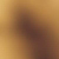 Black heel. reflected light microscopy (groin skin of the heel): Grey-brownish round foci in a st...