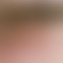 Bläschen:&nbsp;multiple, akute, seit 2 Tagen bestehende, gruppierte, 0,1 cm große, juckende, bren...