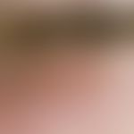 Vesicles: Multiple, acute, grouped, 0.1 cm large, itchy, burning, white, smooth vesicles with a r...