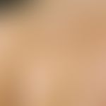 Blaschko-Linien: bogenförmiges Linienmuster, hier bei einem epidermalen Naevus.
