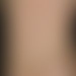 Blaschko-Linien: entlang den Blaschkolinien am Rücken verlaufendes, großflächiges, (diskretes) ep...