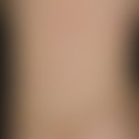 Blaschko-lines: along the Blaschko-lines on the back of a 9-month-old boy a large-area, (discrete...