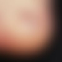 Blase:&nbsp;traumatisch induzierte, subepitheliale Blase bei Epidermolysis bullosa simplex. 7 Jah...