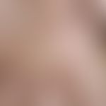 Bubbles: areal blistering in Cheiropompholyx. 32-year-old female patient complaining of recurrent...
