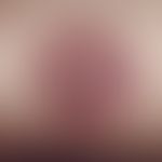 bladder. flaccid bladder with a fixed drug reaction. 43-year-old patient who first developed an i...