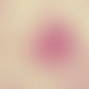 Blastomykose, nordamerikanische. Riesenzelle mit mehreren Blastomyces dermatitidis Zellen; Lunge;...