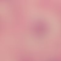 Blastomykose, nordamerikanische:&nbsp;Blastomyces dermatitidis in einer Riesenzelle; Lunge; PAS-F...