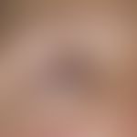 Blepharitis erythematosa. Rötung der freien Lidränder bei einer 33-jährigen Frau mit multipler Sk...