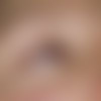 Blepharitis erythematosa. Rötung der freien Lidränder bei einer 33-jährigen Frau mit multipler Sk...