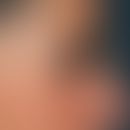 Blepharochalasis: Lateral view of a 49-year-old female patient with open eyes prior to blepharopl...