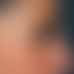 Blepharochalasis: Lateral view of a 49-year-old female patient with open eyes prior to blepharopl...