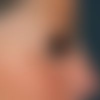 Blepharochalasis: Lateral view of a 49-year-old female patient with open eyes prior to blepharopl...