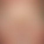 Blepharochalasis: in the 66-year-old patient chronic swelling of the lower eyelids has been prese...
