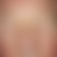 Blepharochalasis: in the 66-year-old patient chronic swelling of the lower eyelids has been prese...