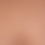 Blue-rubber-bleb-Naevus-Syndrom.
