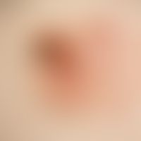 Bowen's carcinoma: Sharply limited superficial scaly plaque, partly crusty, yellow-brown, scaly p...