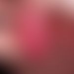 Bowenoide Papulose. 32 Jahre alter Patient, anamnestisch Condylomata acuminata. Nach erfolgreiche...
