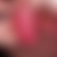 Bowenoide Papulose. 32 Jahre alter Patient, anamnestisch Condylomata acuminata. Nach erfolgreiche...
