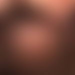 Büschelhaare:Folliculitis decalvans. Im Zentrum spiegelnde Narbenplatte mit dochtartigen Haarbüsc...