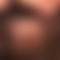Büschelhaare:Folliculitis decalvans. Im Zentrum spiegelnde Narbenplatte mit dochtartigen Haarbüsc...