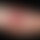 Bulla repens&nbsp;(Impetigo),&nbsp;eingetrübte, hämorrhagische&nbsp;Blase mit Pustelbildung. Koll...