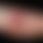 Bulla repens (impetigo), cloudy, haemorrhagic bladder with pustular formation. Collateral inflamm...