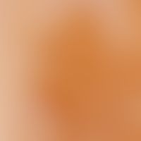 café-au-lait stains. reflected light microscopy: detailed view from a lesion on the thigh in a 36...