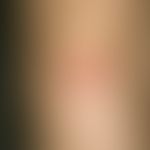 Calcinosis cutis: unscharf begrenzte, zentral krustig belegte, stellenweise steinhart indurierte,...