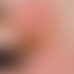 Carcinoma, verrucous. Chronically stationary, slightly increasing in the last 10 years, coarse pl...