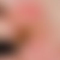 Carcinoma, verrucous. Chronically stationary, slightly increasing in the last 10 years, coarse pl...