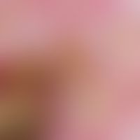 carcinoma, verrucous. detailed view of the chronically stationary skin change. the dry, dirty yel...