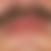 Cheilitis granulomatosa. Circumscribed permanent swelling of the upper lip.