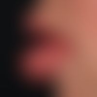Pronounced cheilitis granulomatosa as a monosymptomatic variant of Melkersson-Rosenthal syndrome
