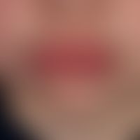 Cheilitis granulomatosa as monosymptomatic variant of the Melkersson-Rosenthal syndrome, central ...