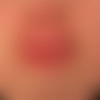 Cheilitis granulomatosa: bulging, firm swelling of lower and upper lip.
