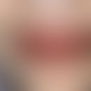 Cheilitis plasmacellularis: Lacquer-like shiny lips with multiple ulcerations in the area of the ...